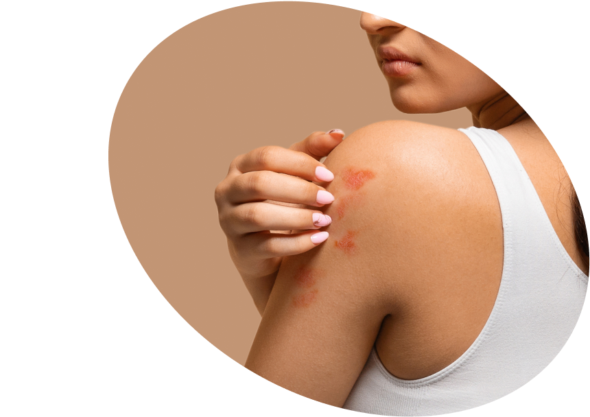 Psoriasis on the Body - Shop Soothing Body Care Products USA