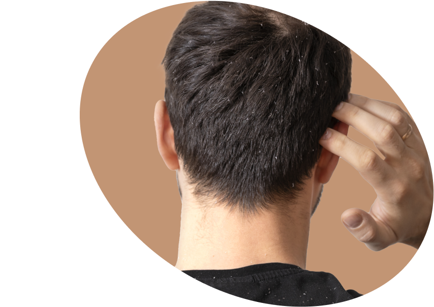 Dandruff - Shop Purifying Shampoo for Dry &amp; Oily Dandruff USA
