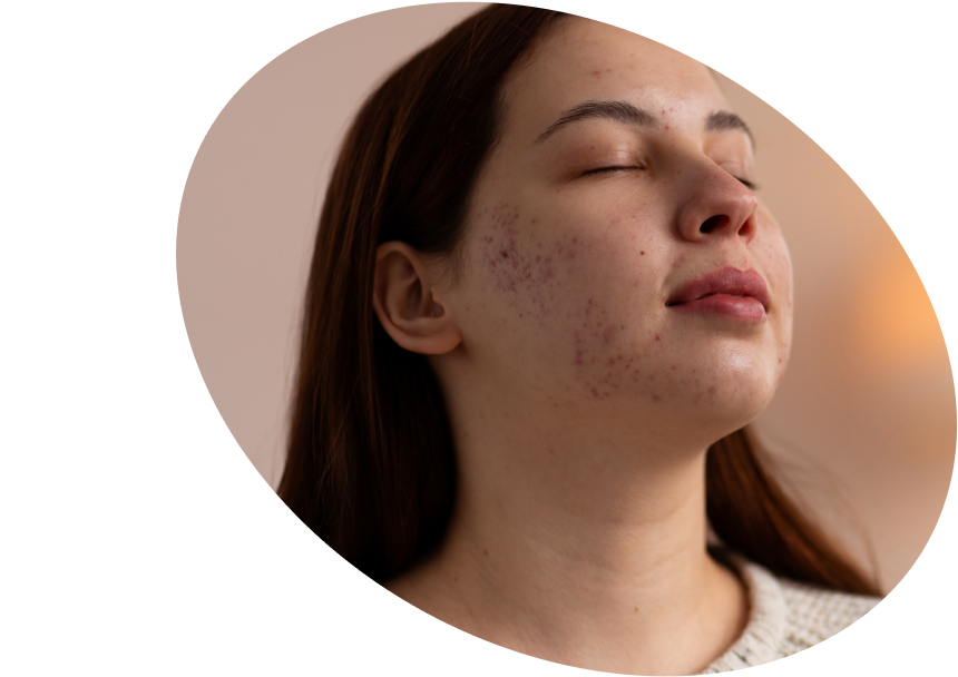Acne Skincare - Shop Serums &amp; Creams for Acne &amp; Pimples USA