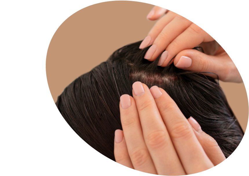 Scalp Psoriasis Solutions Shop - Relief for Scalp Psoriasis USA
