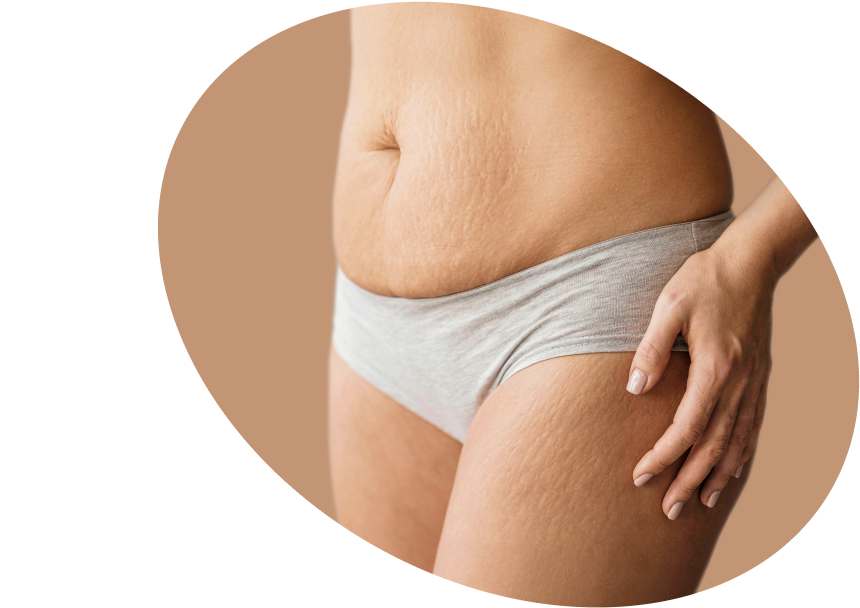 Stretch Marks - Shop Creams to Prevent &amp; Treat Stretch Marks USA