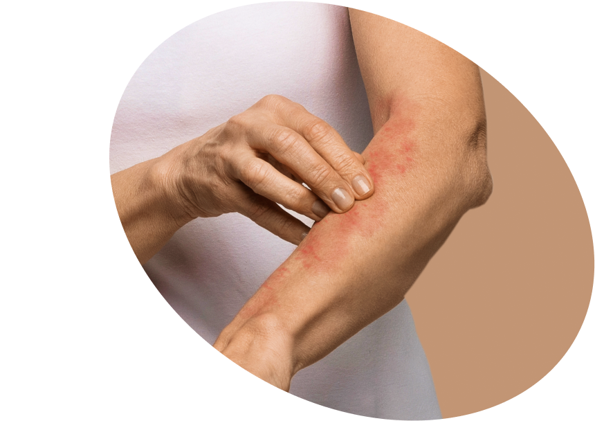 Eczema on the Body - Shop Soothing Skincare Products USA