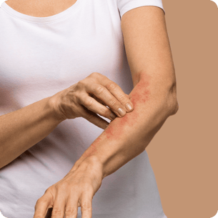 Eczema